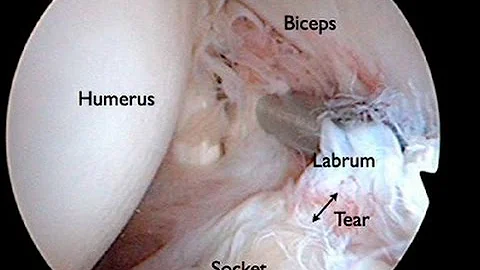 HELP I TORE MY LABRUM!!