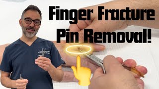 How I remove pins from finger fractures in my office! - Orthopedic Hand Surgeon Peter DeNoble, MD