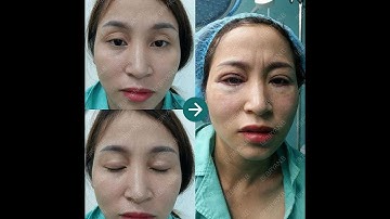 Sửa Lỗi Thẩm Mỹ Cắt Mí Mắt Lỗi - Viện thẩm mỹ D’Vincy