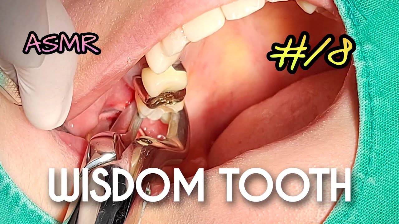 [ASMR] Wisdom Tooth Extraction - YouTube