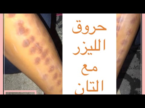 أوعى تتحرقى لو عامله تان وعايزه تعملى ليزر