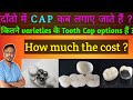 Types of Tooth Caps and cost | दाँतो की कैप एवं खर्च || Dental crowns - metal/ceramic/metal free