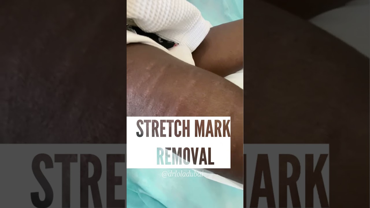 How To Remove Stretch Marks Permanently