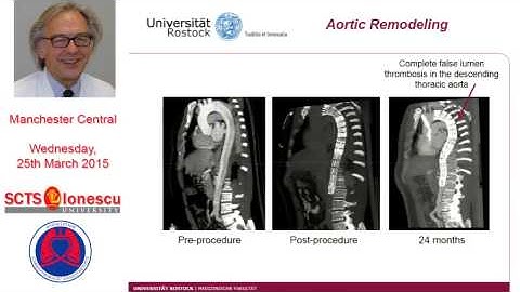 TEVAR in chronic type B aortic dissection