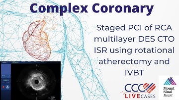 Staged PCI of RCA multilayer DES CTO ISR using rotational atherectomy and IVBT