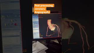 Coronary angiogram CT post processing #digitalcreator #medical #viralvideo #science #contentcreat