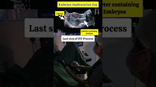 Embryo transfer procedure in IVF by Dr Rakshita Malik #ivftreatmentforpregnancy #embryotransfer #ivf