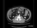 Carcinoid Tumor/Mesenteric Carcinoid(Case findings)
