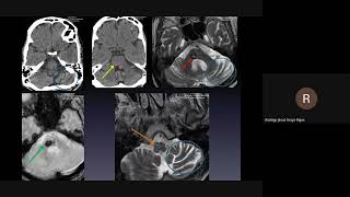 Casos de neurorradiología (TRIVIA) 03-06-26 Casos de neurorradiología (TRIVIA) 03-06-26