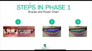 Steps in Phase 1 Braces and Power Chain