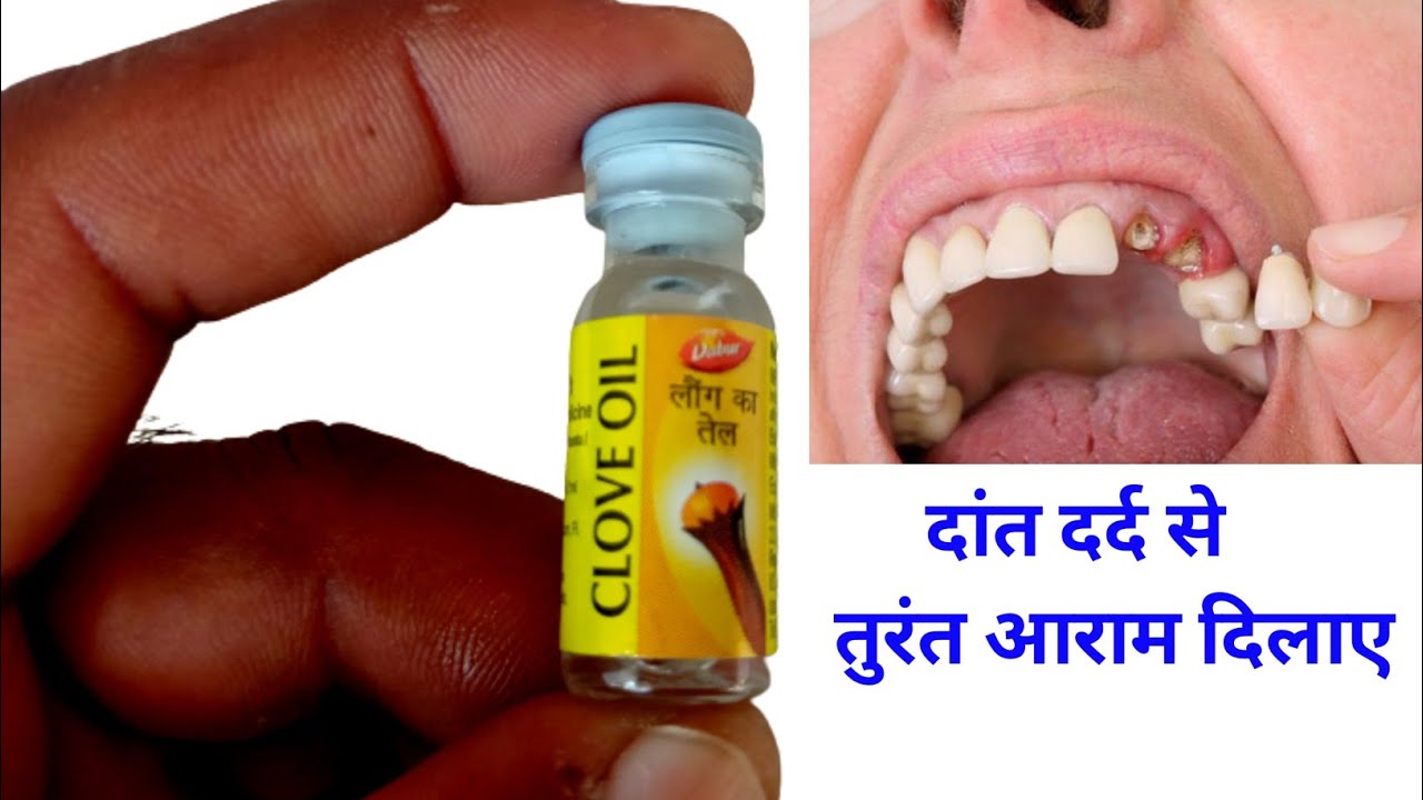 Clove oil,use of clove oil in toothache and how it give Relife from