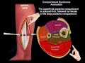 Acute and chronic leg Compartment Syndrome    - Everything You Need To Know - Dr. Nabil Ebraheim