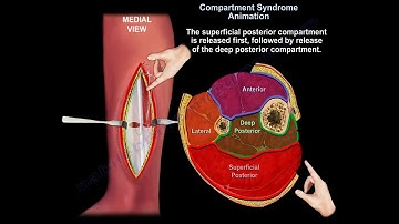 Acute and chronic leg Compartment Syndrome    - Everything You Need To Know - Dr. Nabil Ebraheim