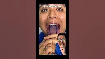 ¿Qué busca el dentista en tu lengua?