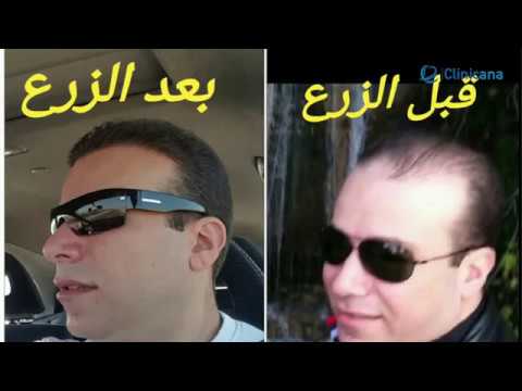 تجربة زراعة الشعر