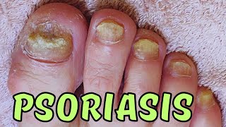 Psoriatic toenails satisfying treatment.