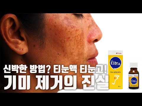 티눈액 기미 제거 하면 안되는 이유