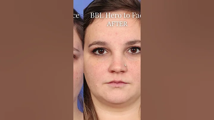 Look at these results of our patience after her BBL HERO facial procedure 😱 #selfcare