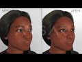 African American Nose Video endoscopic ethnic rhinoplasty, Alarplasty by Yakup Avşar Istanbul Turkey