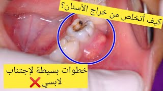 خراج الأسنان Abcès dentaire/أسباب/وقاية/علاج/وصفات طبيعية للقضاء على خراج الأسنان