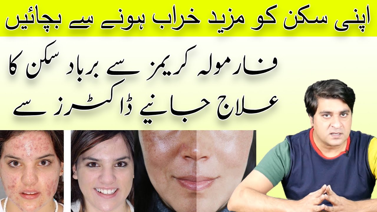 Formula Cream Damage Skin Steroid Cream Side Effects treatment