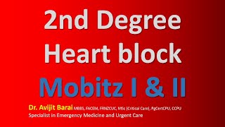 AskDrBarai: 2nd Degree Heart block II Second Degree AV Block II ECG Made Super Easy