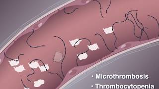 Improving Outcomes in TTP