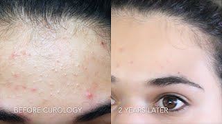 CUROLOGY REVIEW: 2 YEARS LATER + Drugstore Skin Care Routine for Acne