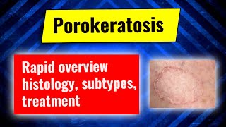 Porokeratosis: overview, clinical subtypes, histology, treatment options. Dermatology review series