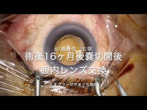 後嚢切開後の眼内レンズ交換手術（67歳男性 初回術後16ヶ月, ３焦点→単焦点,支持部切断,嚢外固定）※手術動画