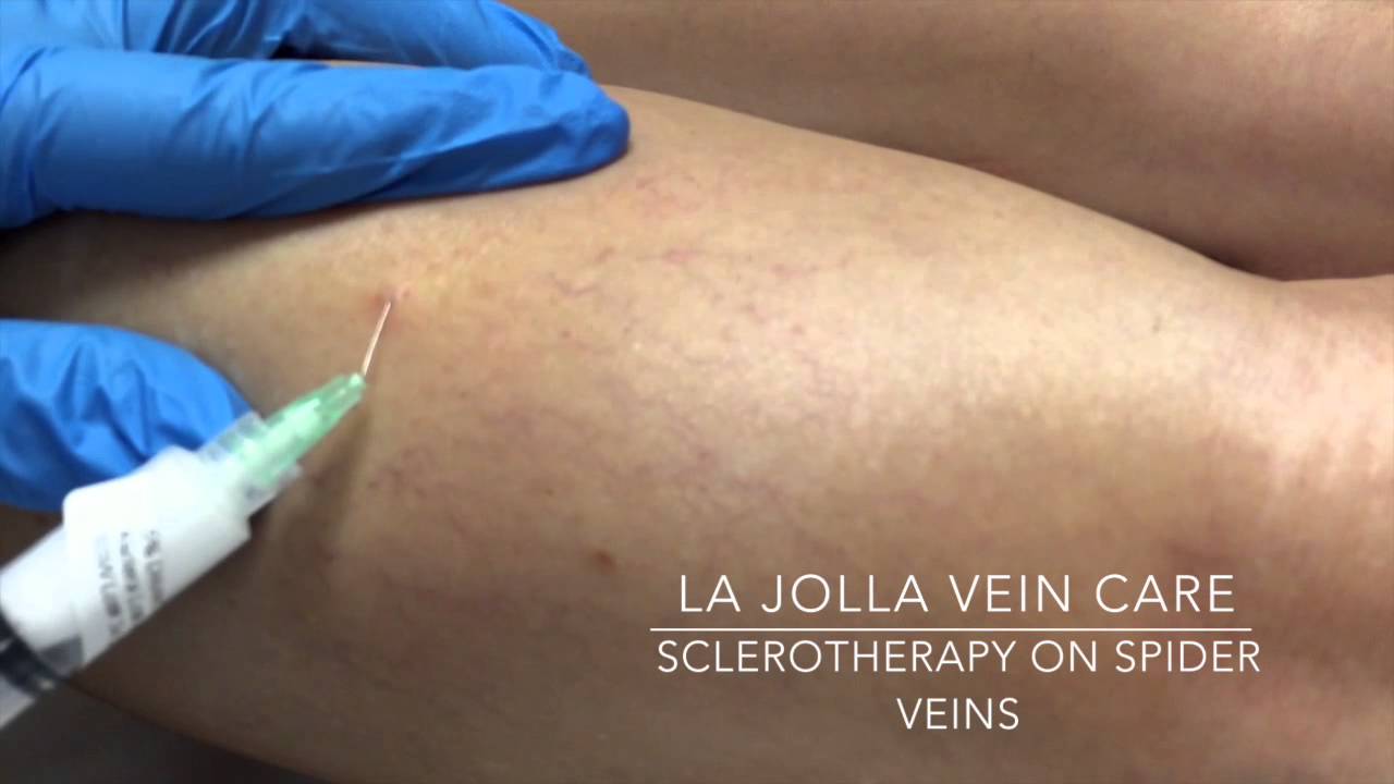 Video: Spider Vein Sclerotherapy 8 YouTube player