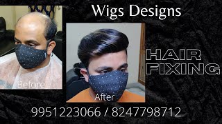 Hair Fixing in Bangalore 8247798712