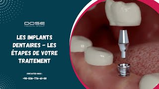 Implants dentaires - Les différentes étapes de votre traitement