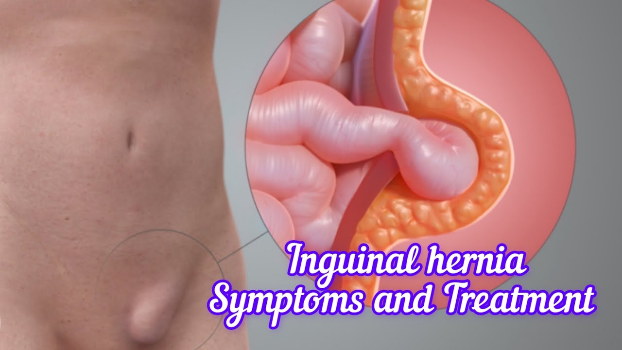 Inguinal Hernia Symptoms & Treatment