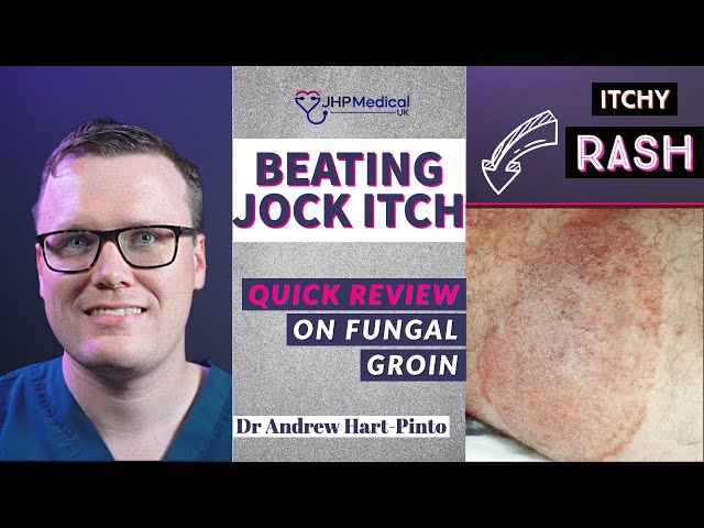 Doctor explains how to RECOGNISE AND TREAT JOCK ITCH (aka Tinea