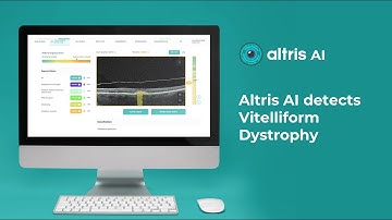 AI detects Vitelliform Dystrophy on OCT