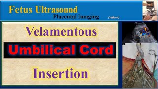 Fetus Ultrasound, Velamentous Umbilical Cord Insertion