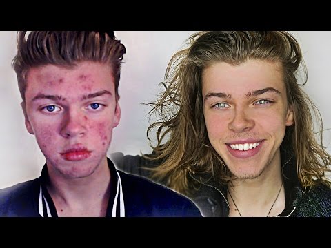 MY ACNE STORY - BEFORE & AFTER!