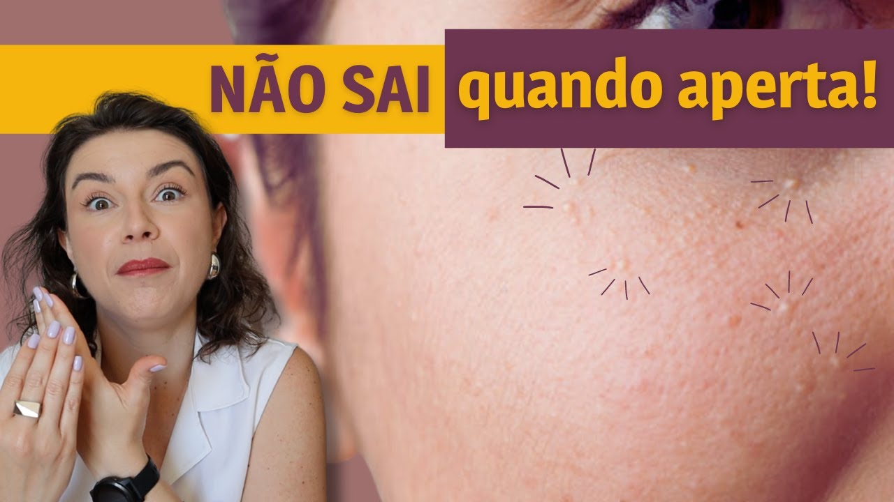 Porque eu tenho milium? Como que tira milium do rosto? - YouTube