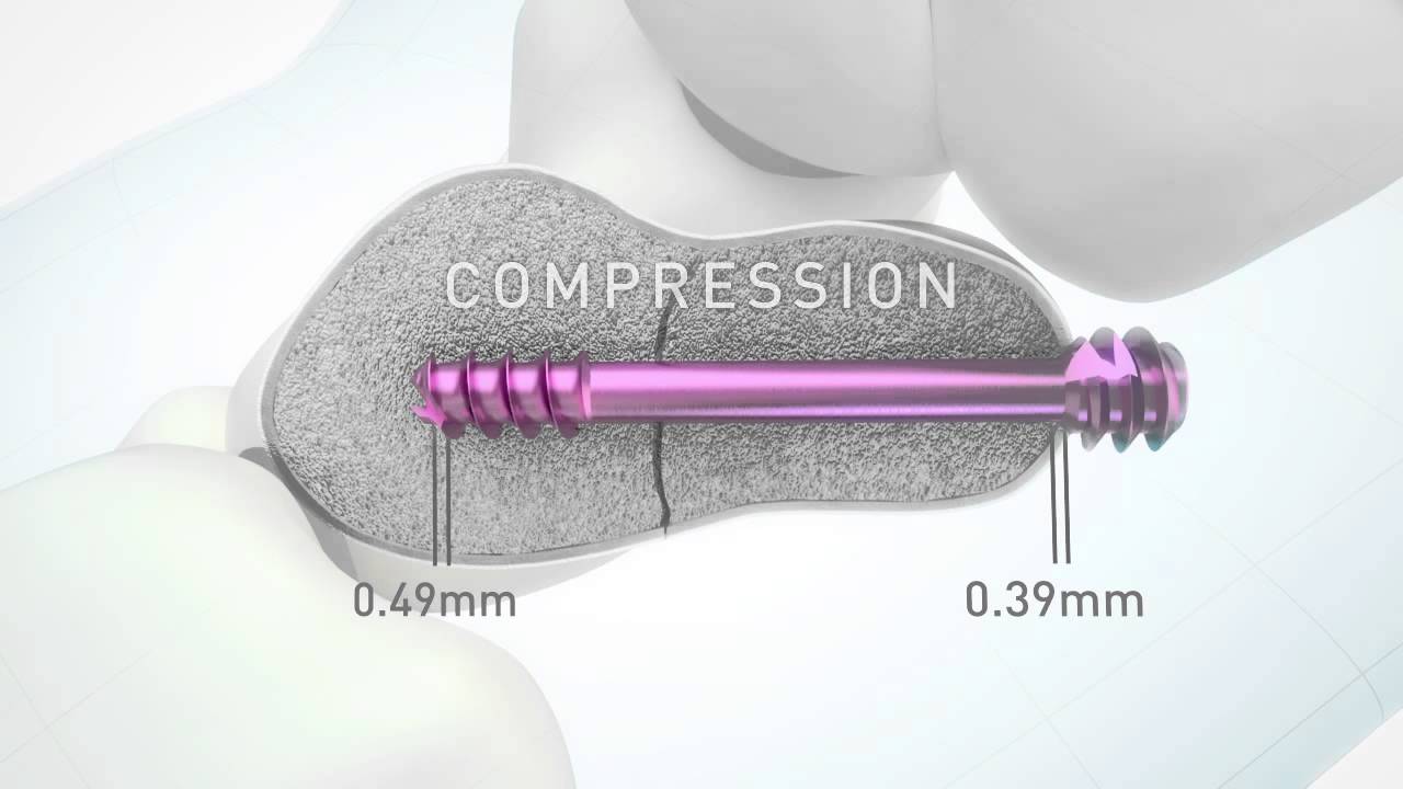 HBS 2 Headless bone screw by KLS Martin YouTube