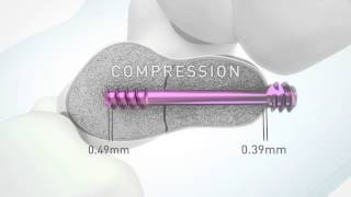 HBS 2  Headless bone screw by KLS Martin