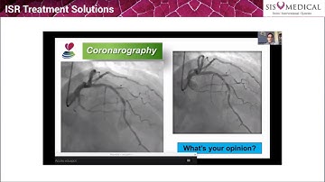 Webinar hosted by SIS Medical on OPN NC- Ultra High Pressure Plaque Modification Device.