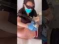Pulsed Dye Laser Minimizes The Appearance Of Redness In Red Stretch Marks 