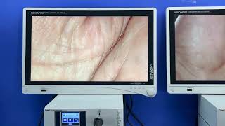Two Stryker 1488 HD Laparoscopy Stack System