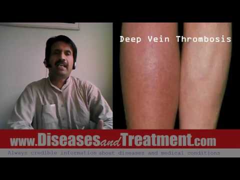 deep-vein-thrombosis-(dvt)-:-causes,-diagnosis,-symptoms,-treatment,-prognosis