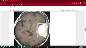 Brain Tumor Detection using YOLOv11 and SAM2