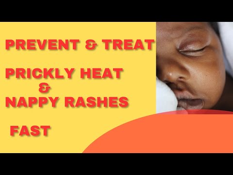 Honest Review On Agnesia Baby Powder|How to use|Kids & Teens|Prickly Heat & Nappy Rashes
