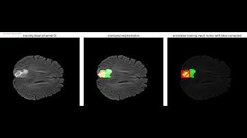 Brain Tumor Detection | Mask R-CNN |   Medical Decathlon dataset | python