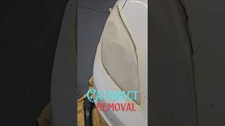 How to remove Cataract at Home