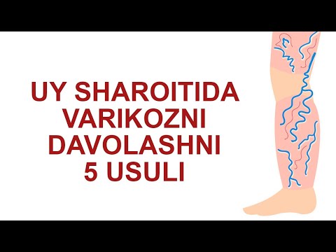 Varikozni Uy Sharoitida Davolashni 5 Usuli